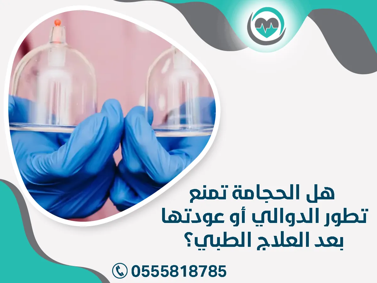 الحجامة تمنع تطور الدوالي أو عودتها بعد العلاج