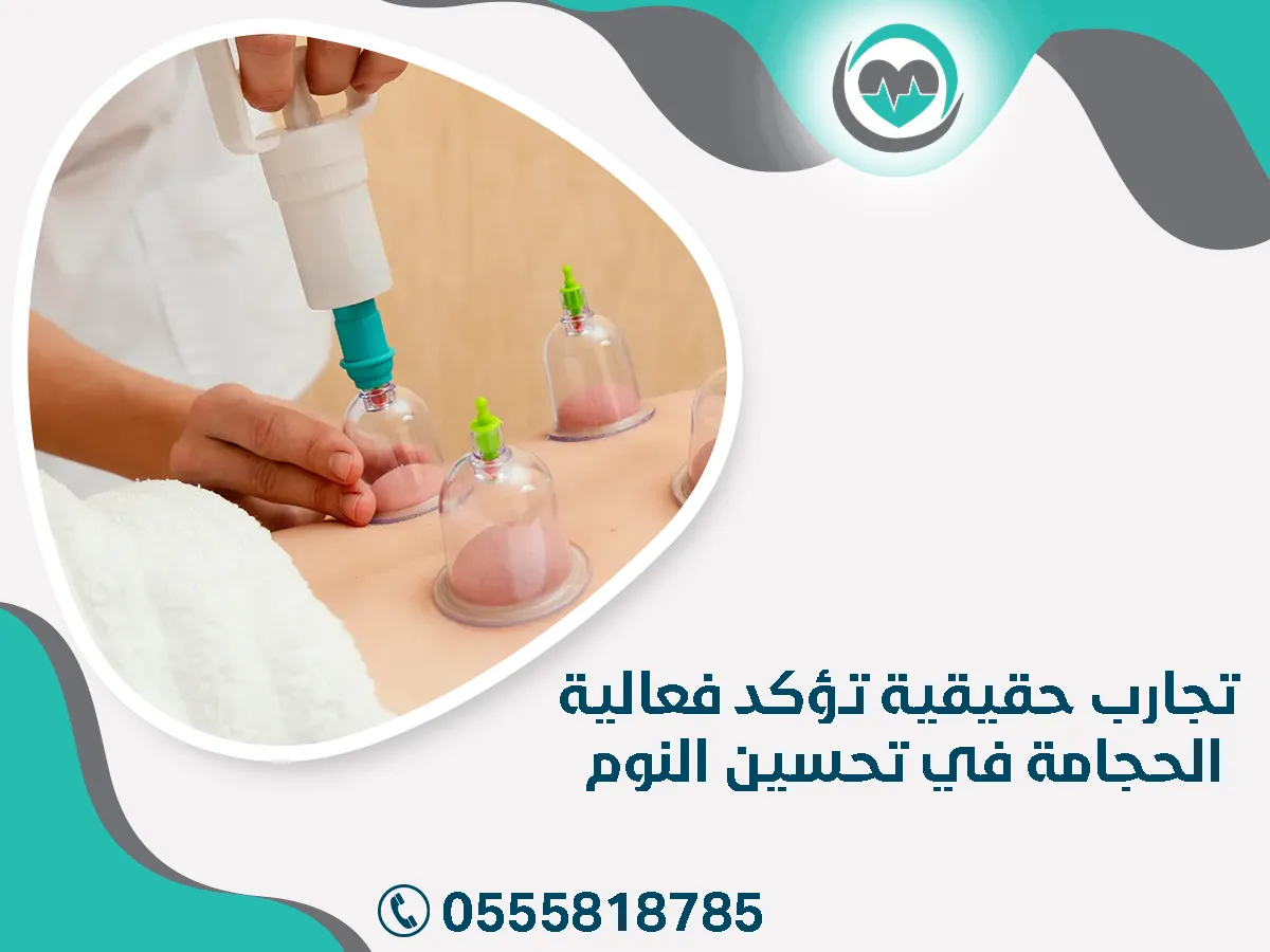 تجارب تؤكد فعالية الحجامة في تحسين النوم