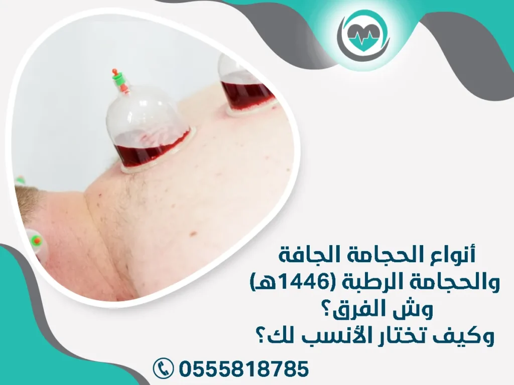 أنواع الحجامة الجافة والحجامة الرطبة (1446هـ) – وش الفرق؟ وكيف تختار الأنسب لك؟