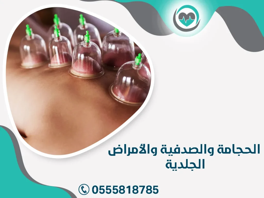 الحجامة والصدفية والأمراض الجلدية