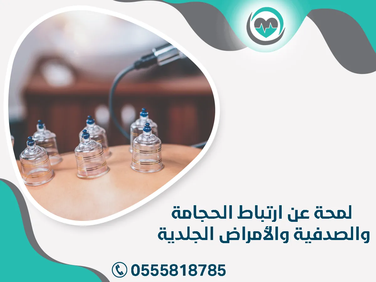 لمحة عن ارتباط الحجامة والصدفية 