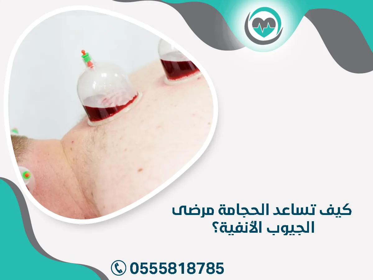 تساعد الحجامة مرضى الجيوب الأنفية