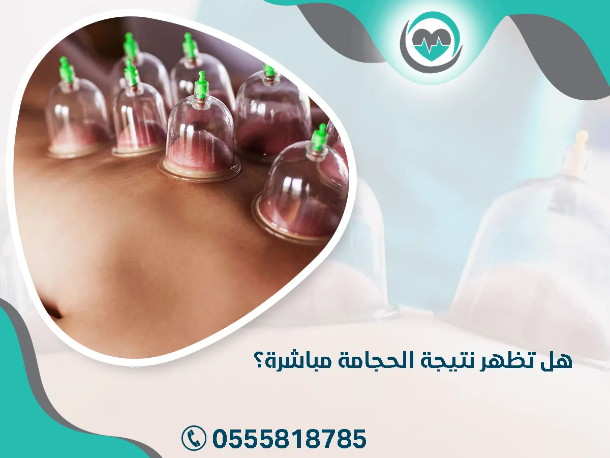 هل تظهر نتيجة الحجامة مباشرة؟