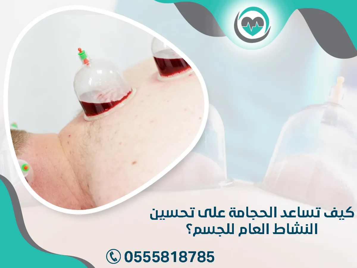 كيف تساعد الحجامة على تحسين النشاط العام للجسم