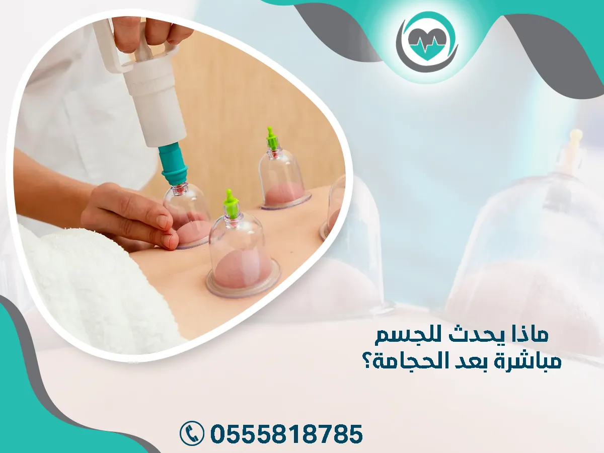 ما يحدث للجسم مباشرة بعد الحجامة