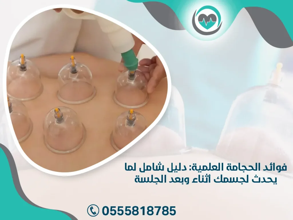 فوائد الحجامة العلمية