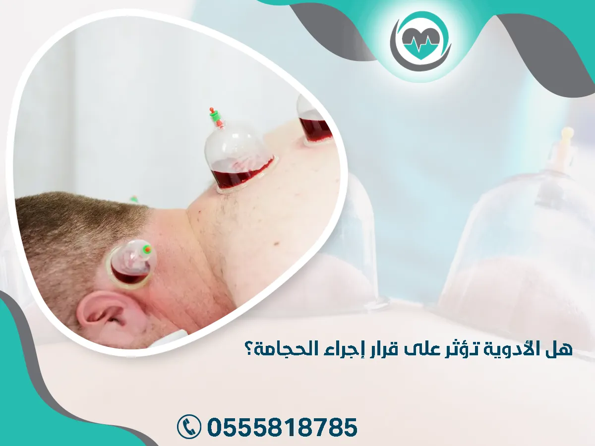 الأدوية تؤثر على قرار إجراء الحجامة