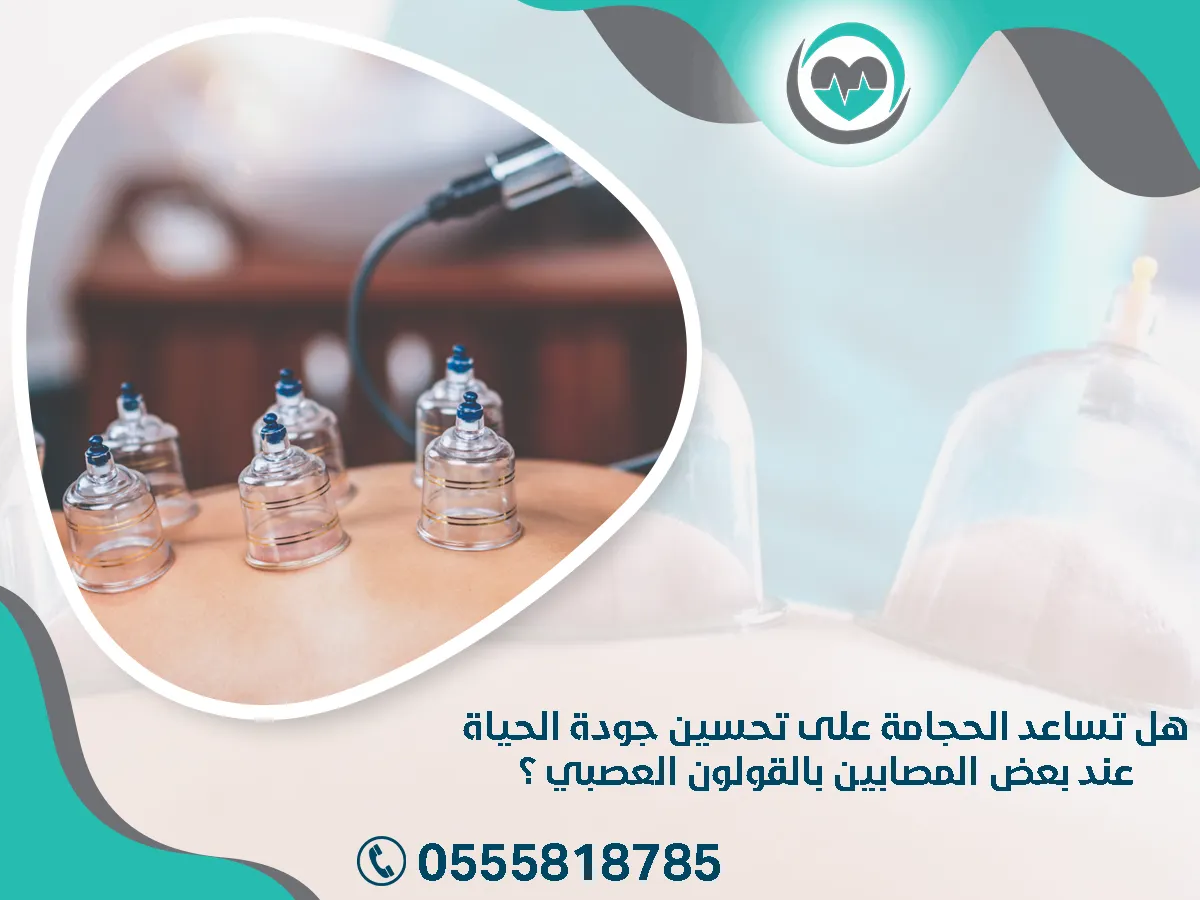 تساعد الحجامة على تحسين جودة الحياة عند بعض المصابين بالقولون العصبي