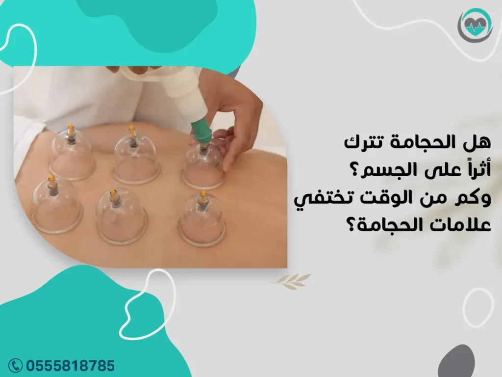 هل الحجامة تترك أثراً على الجسم؟ وكم من الوقت تختفي علامات الحجامة؟ | 1447هـ