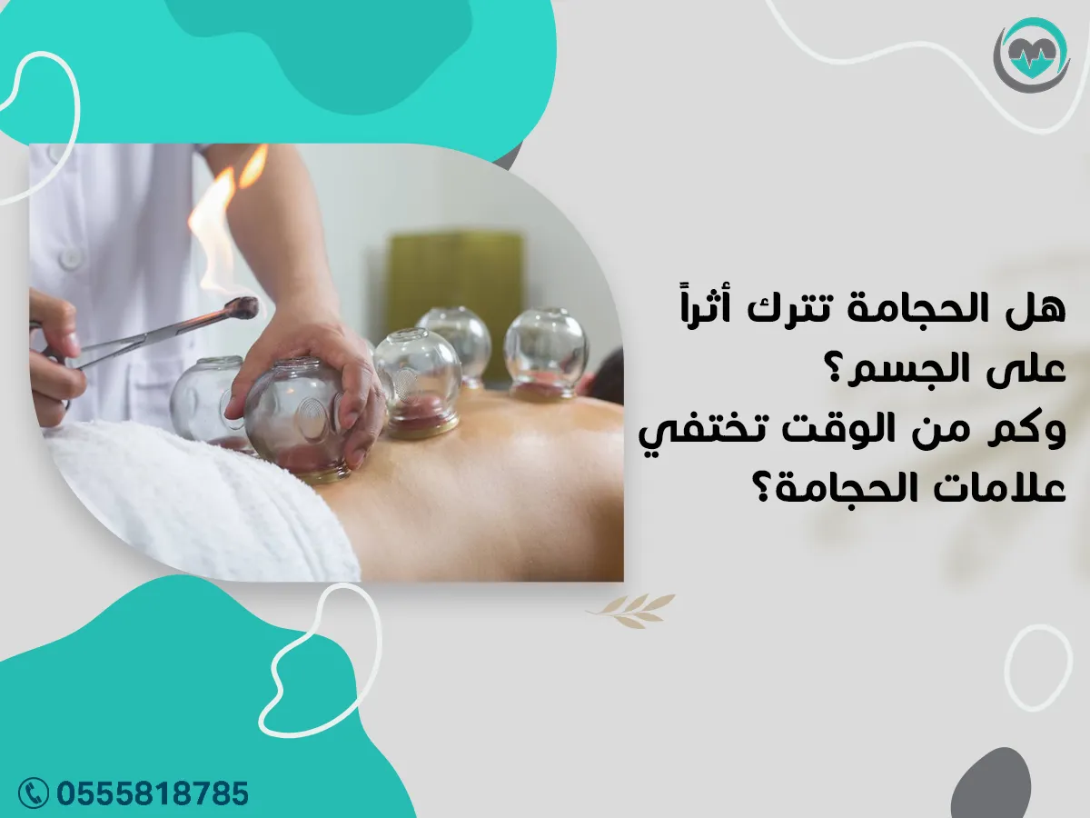 علامات الحجامة
