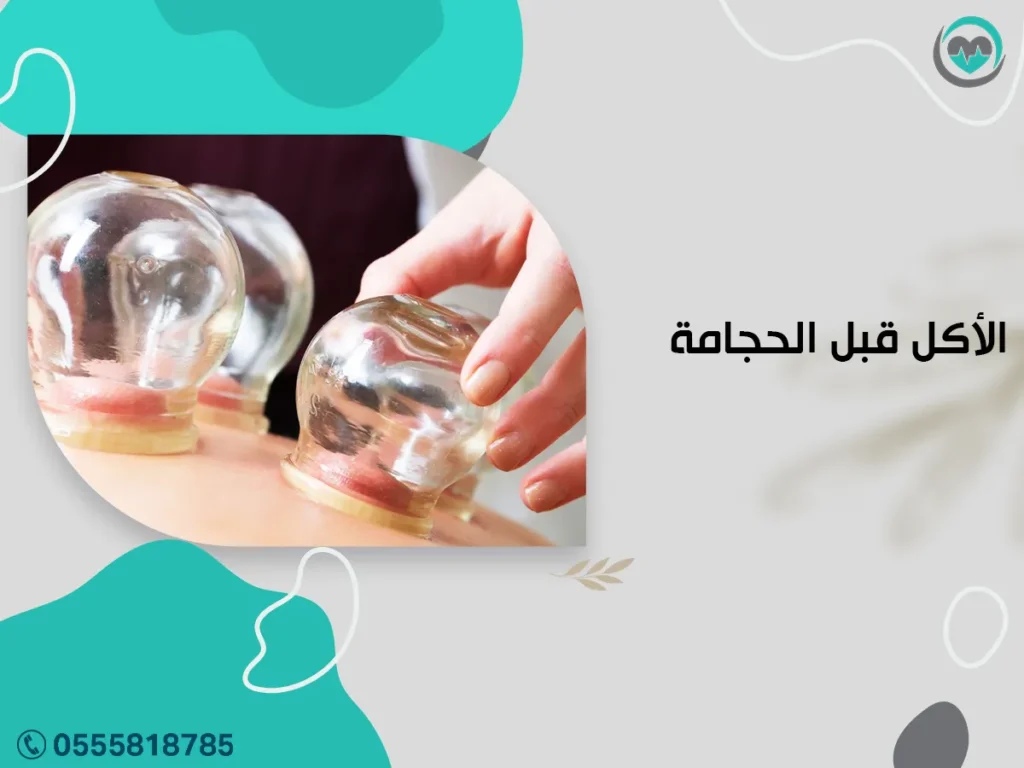 الأكل قبل الحجامة